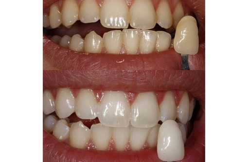 Безопасное косметическое экспресс отбеливание зубов - Magic White, 100% результат - Косметологические услуги в Севастополе