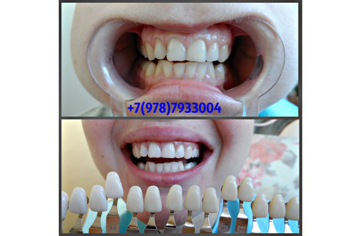 Безопасное косметическое экспресс отбеливание зубов - Magic White, 100% результат - Косметологические услуги в Севастополе