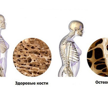 Диагностика остеопороза в Феодосии и Крыму – медицинский Центр «Доктор Баден» - Медицинские услуги в Феодосии
