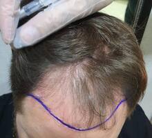 Обучение пересадка волос - Курсы учебные в Крыму