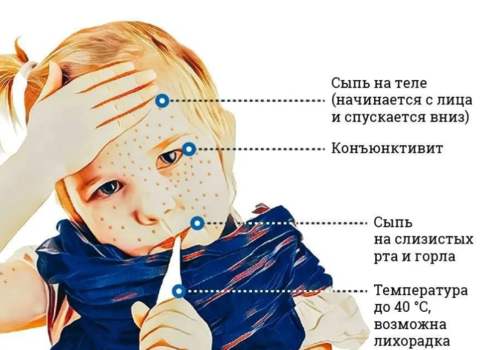 Число случаев заболевания корью в Крыму превысило два десятка впервые за 10 лет