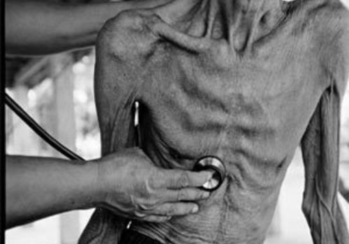 Крымчане в опасности: их заражают туберкулёзом приезжающие на лечение