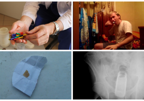 "Я проходила с инородным телом в десне 10 лет!": необычные предметы, которые медики доставали из крымчан