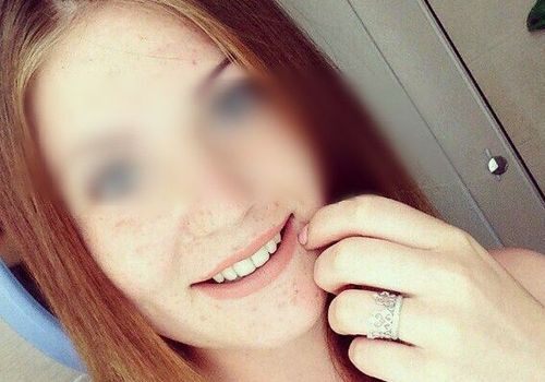 В Крыму собирают деньги на лечение 19-летней девушки, которую поджег молодой человек