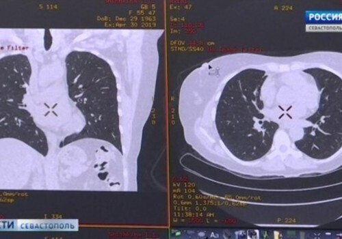 Севастопольцы смогут пройти бесплатное обследование на компьютерном томографе