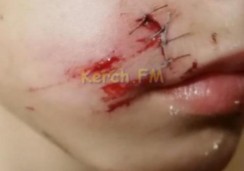 Ребенок  разорвал лицо, когда бежал вдоль бутиков у центрального рынка Керчи ВИДЕО