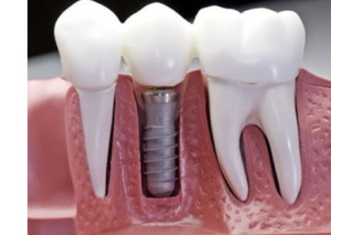 Имплантация зубов в Ялте – где можно сделать