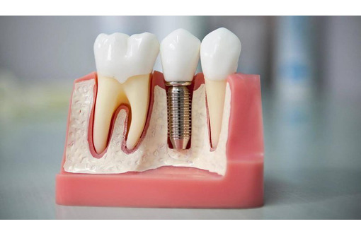 Имплантация зубов в Керчи: где делают
